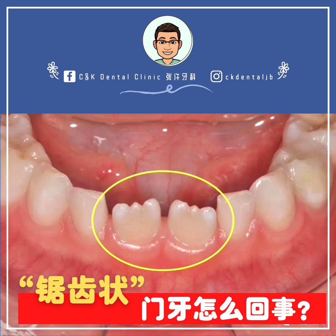 Wisdom Tooth
